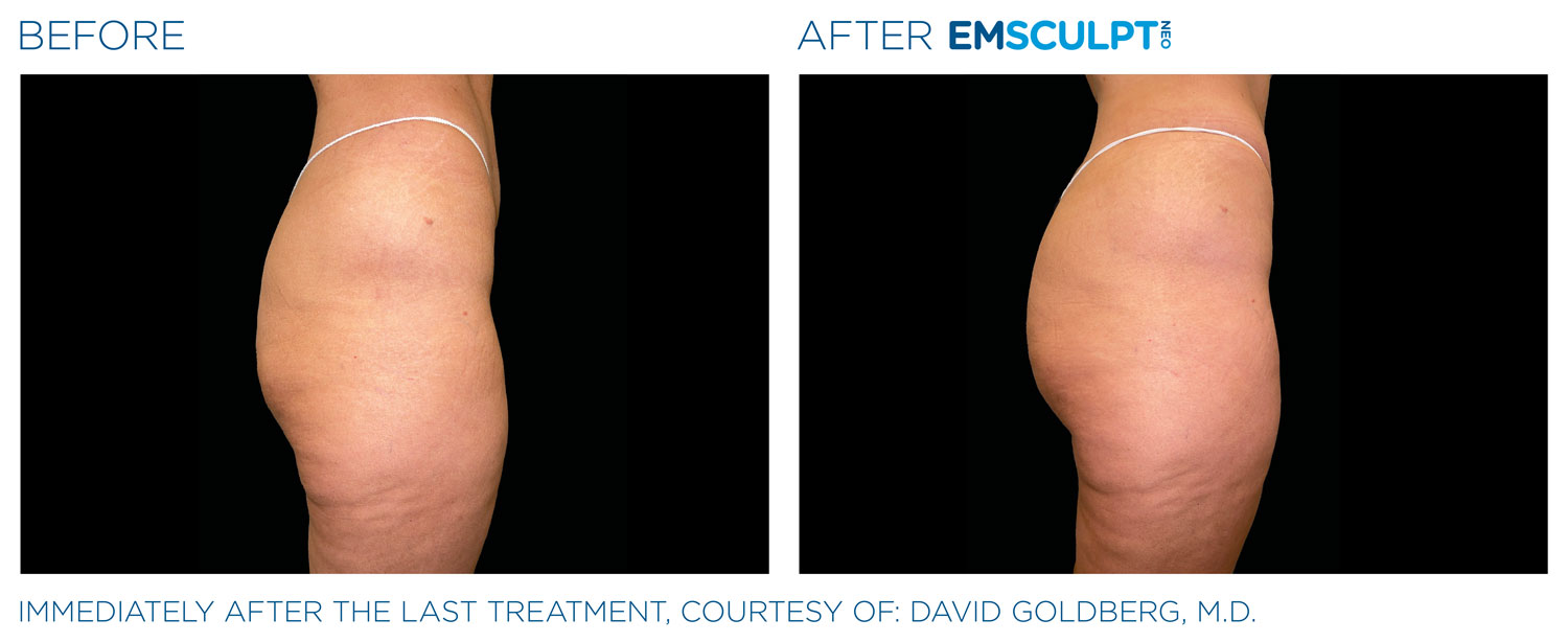 Immediately Results of EMSCULPT NEO� Treatment  to achieve more lifted, plump buttocks
