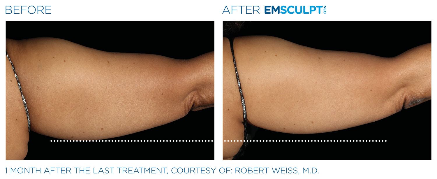 Before and After Results of EMSCULPT NEO� Treatment for Arms 
